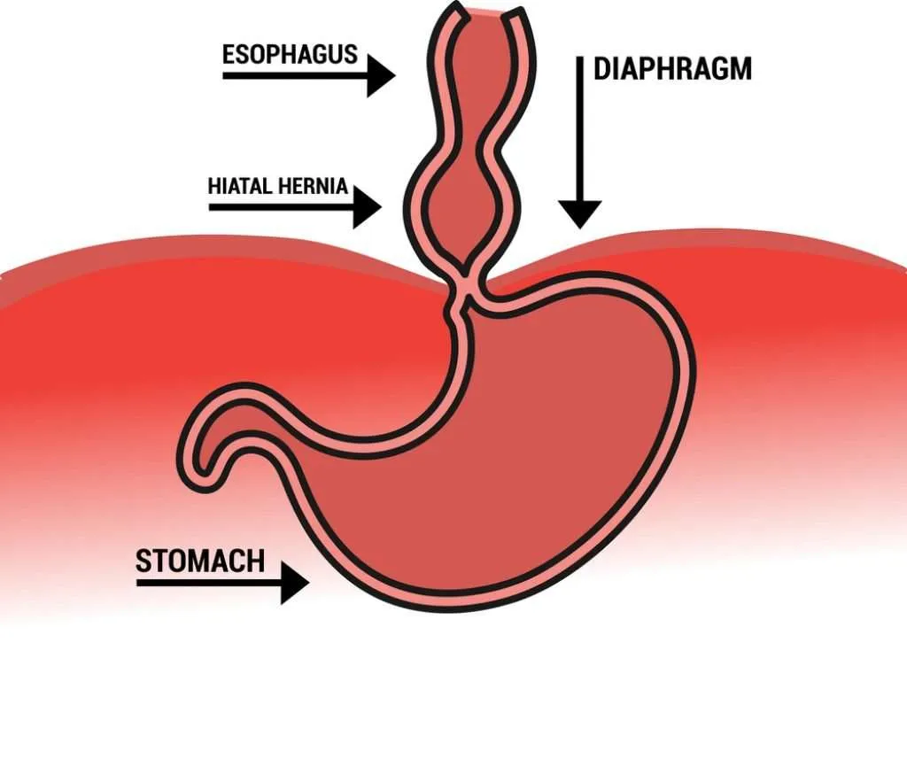 Define Hiatal Hernia