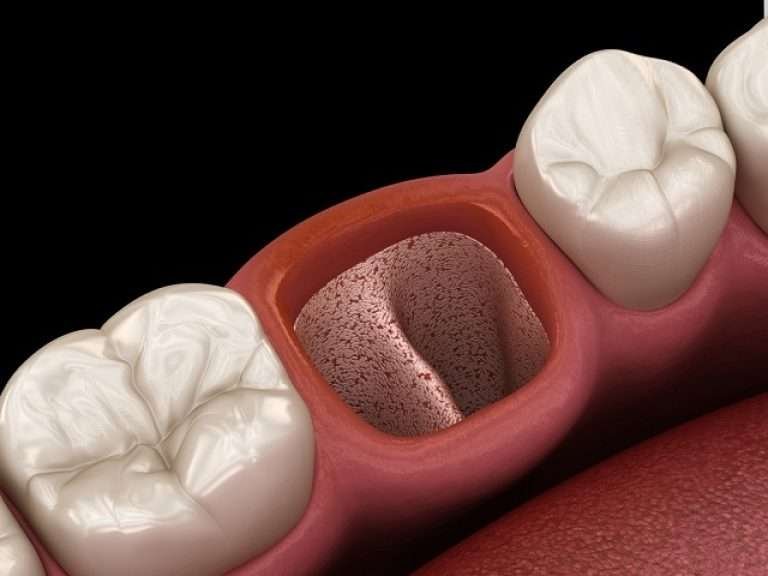 4 Simple Remedies of Bad Taste In Mouth After Tooth Extraction