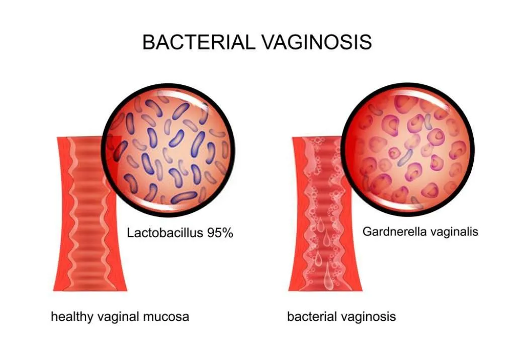 bacterial-vaginosis