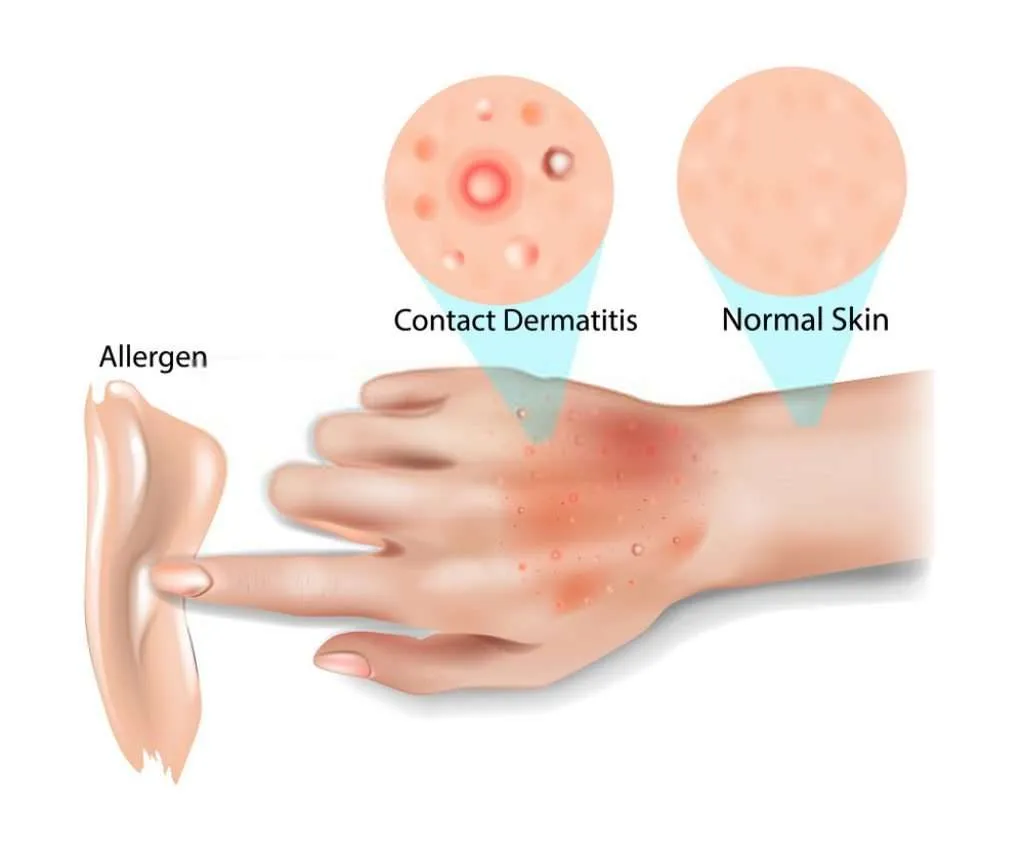 contact-dermatitis