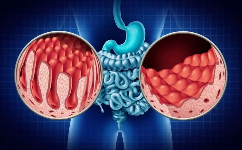 malabsorption
