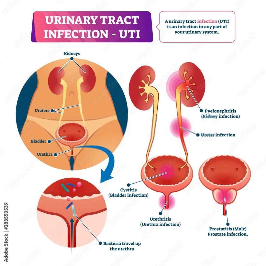 UTI