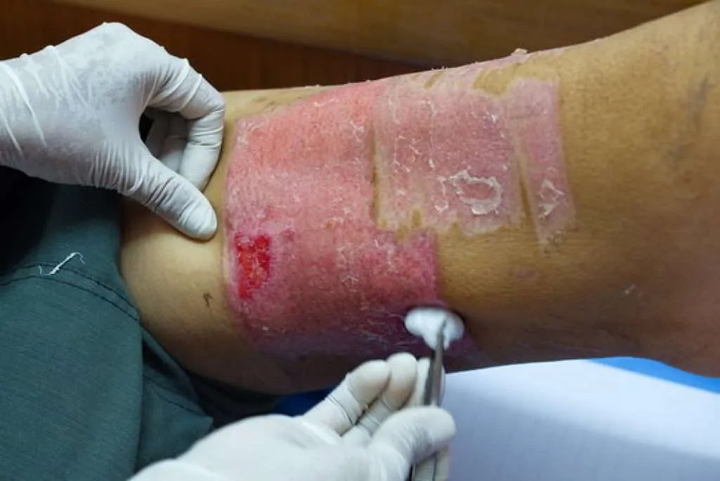 full-thickness-skin-graft