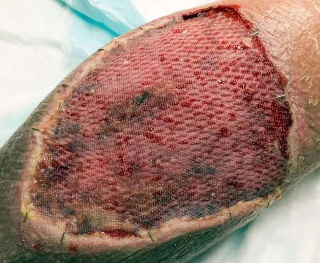 split-thickness-skin-graft