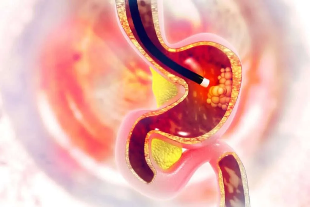 hurts-to-eat-after-endoscopy