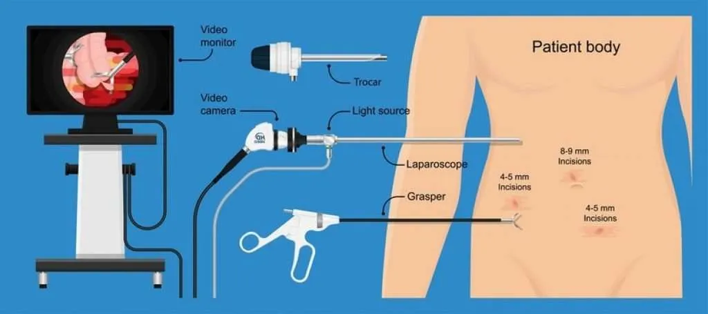 endoscopy-process