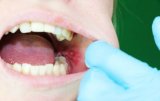4 Ways to Prevent Wisdom Teeth Stitches Came Out