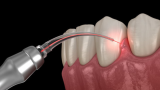 Frenectomy Ruined My Smile