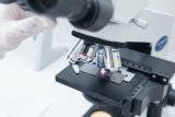 What Percentage of Prostate Biopsies Are Cancerous? Understanding the Odds and What It Means for You