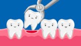 Eating Habits & Tooth Extraction: Can I Eat Rice After Tooth Extraction?